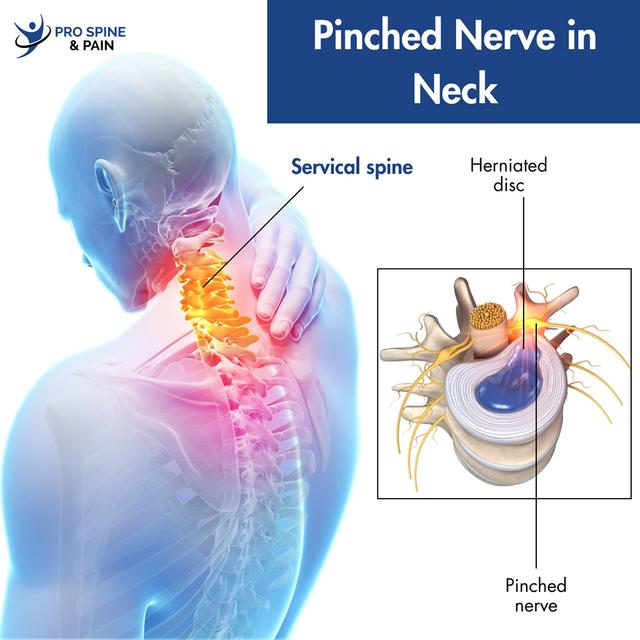 pinched-nerve-in-the-neck.jpg
