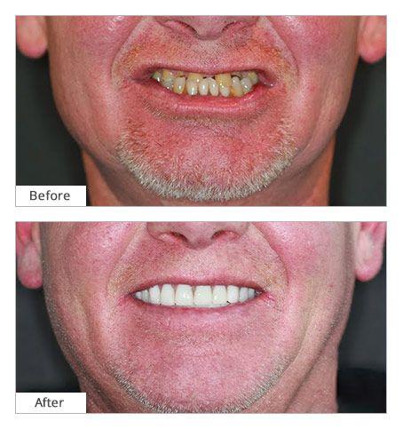 dental-implant-procedure.jpg