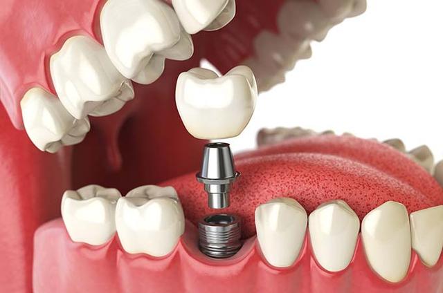 dental-implant-open-jaw.jpg