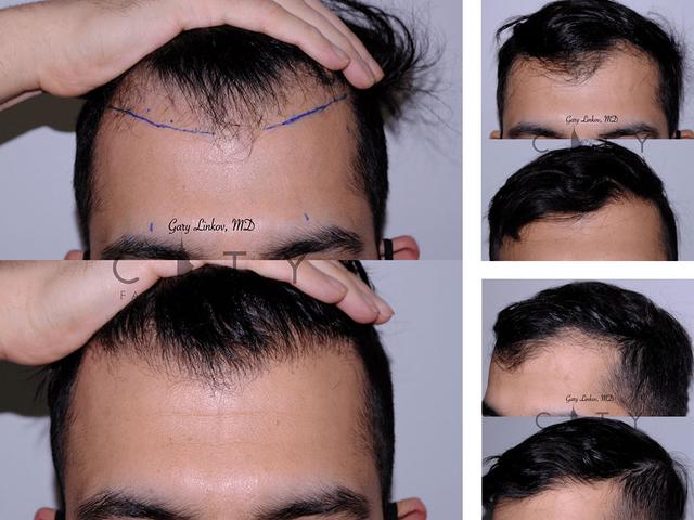 hair-transplant-nyc-case-1.jpg